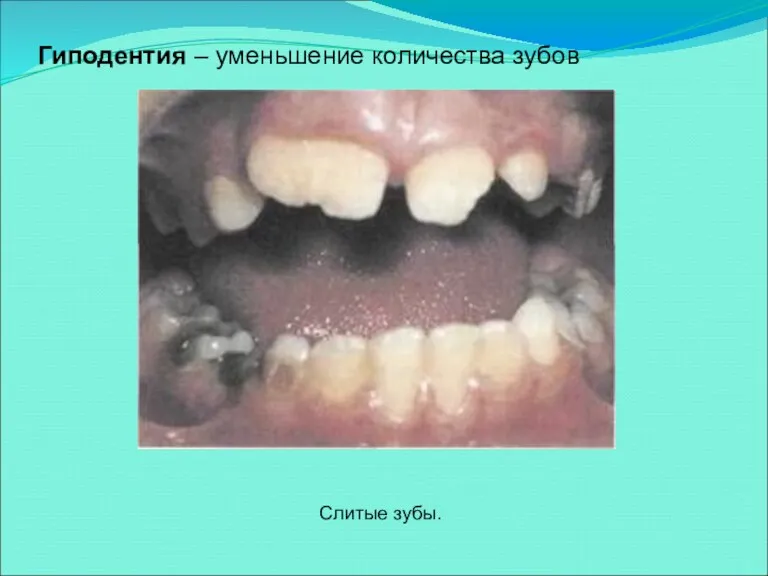 Гиподентия – уменьшение количества зубов Слитые зубы.