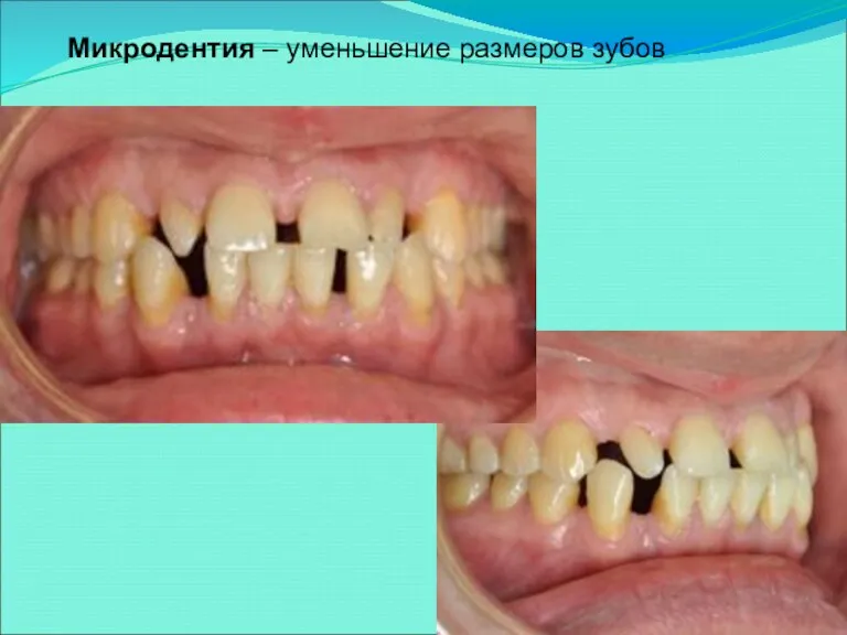 Микродентия – уменьшение размеров зубов