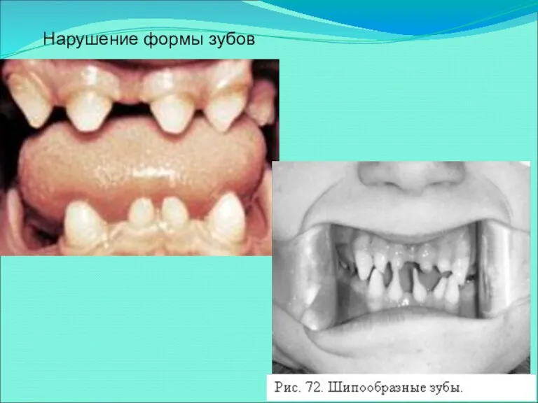 Нарушение формы зубов