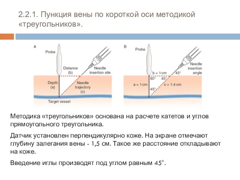 2.2.1. Пункция вены по короткой оси методикой «треугольников». Методика «треугольников»