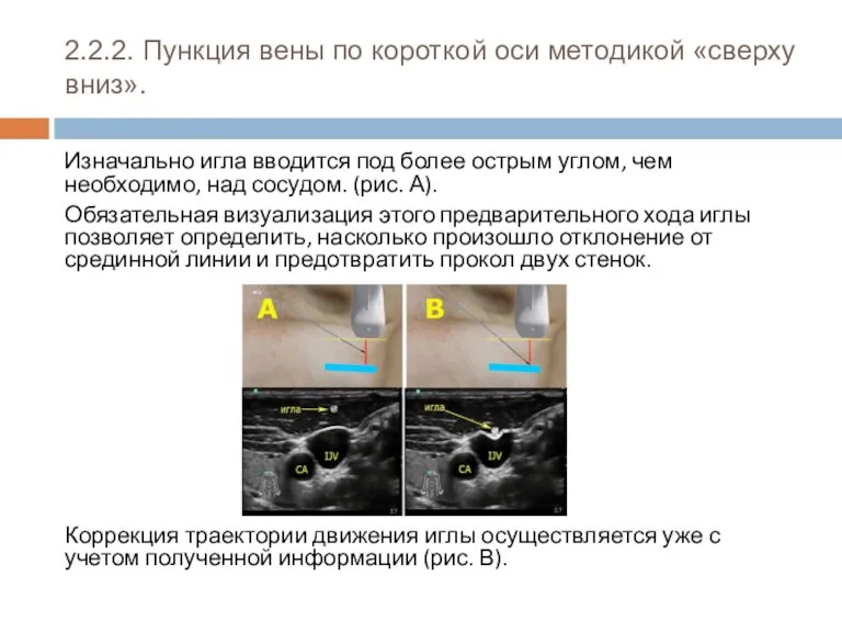 2.2.2. Пункция вены по короткой оси методикой «сверху вниз». Изначально