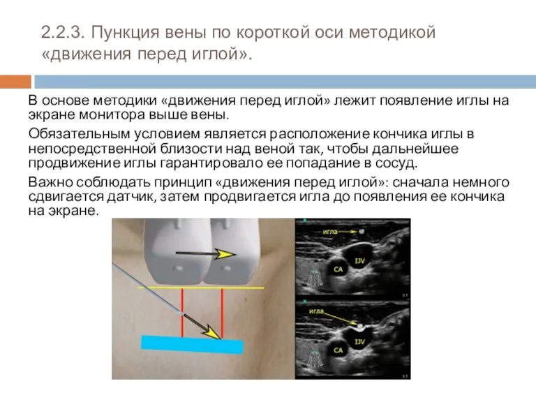 2.2.3. Пункция вены по короткой оси методикой «движения перед иглой».