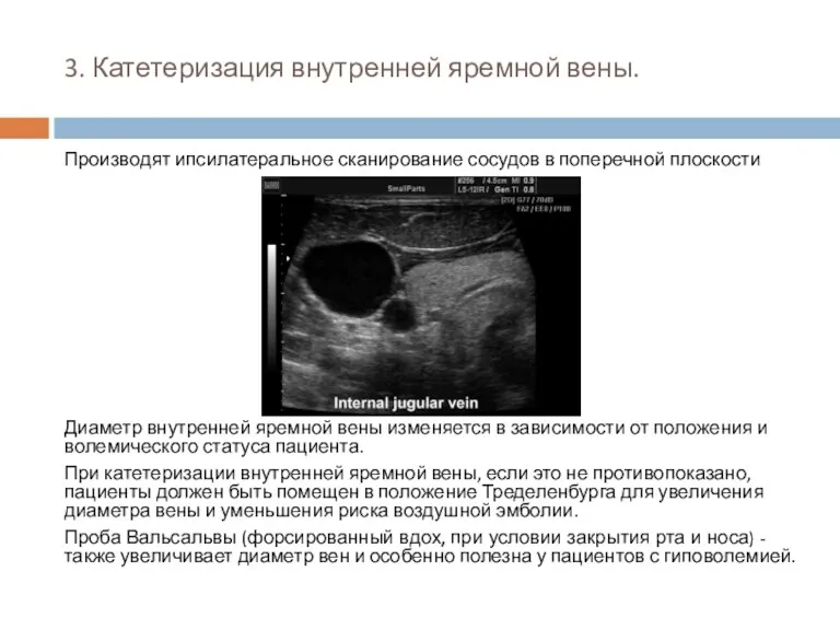 3. Катетеризация внутренней яремной вены. Производят ипсилатеральное сканирование сосудов в