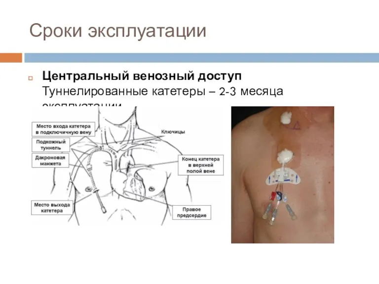 Сроки эксплуатации Центральный венозный доступ Туннелированные катетеры – 2-3 месяца эксплуатации.