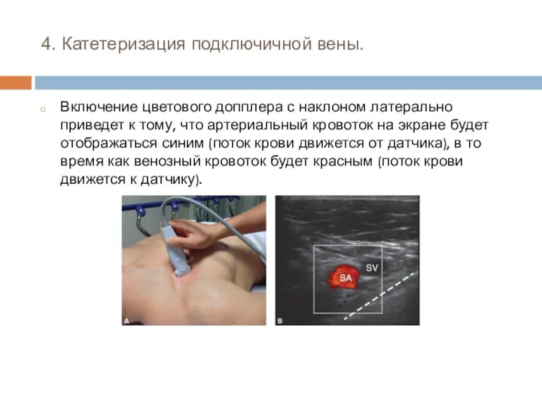 4. Катетеризация подключичной вены. Включение цветового допплера с наклоном латерально