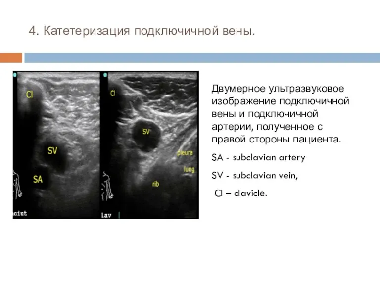 4. Катетеризация подключичной вены. Двумерное ультразвуковое изображение подключичной вены и