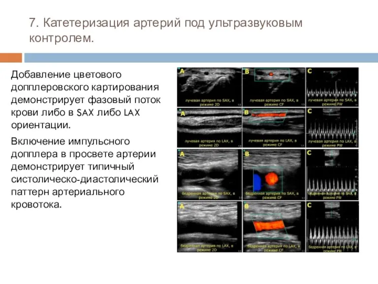 7. Катетеризация артерий под ультразвуковым контролем. Добавление цветового допплеровского картирования