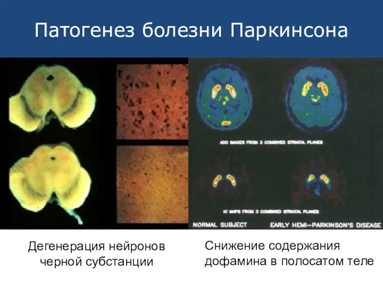 Патогенез болезни Паркинсона Снижение содержания дофамина в полосатом теле Дегенерация нейронов черной субстанции