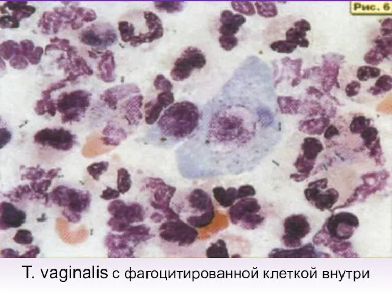 T. vaginalis с фагоцитированной клеткой внутри