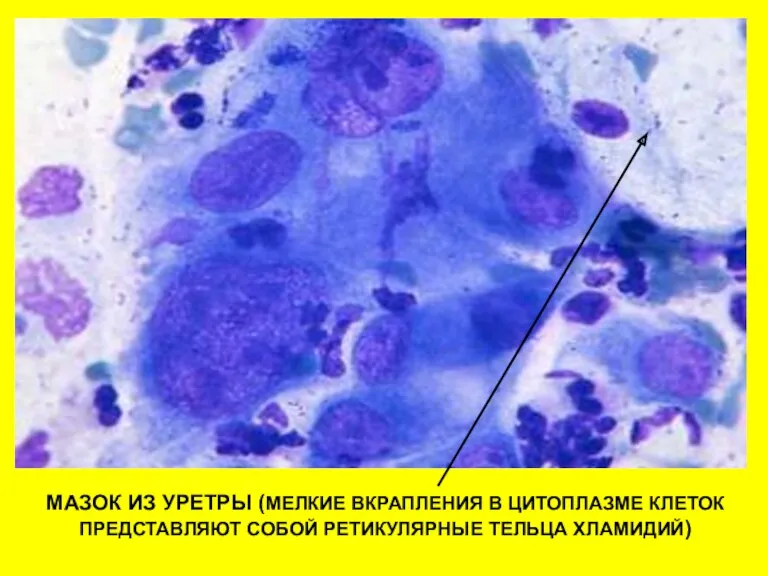 МАЗОК ИЗ УРЕТРЫ (МЕЛКИЕ ВКРАПЛЕНИЯ В ЦИТОПЛАЗМЕ КЛЕТОК ПРЕДСТАВЛЯЮТ СОБОЙ РЕТИКУЛЯРНЫЕ ТЕЛЬЦА ХЛАМИДИЙ)