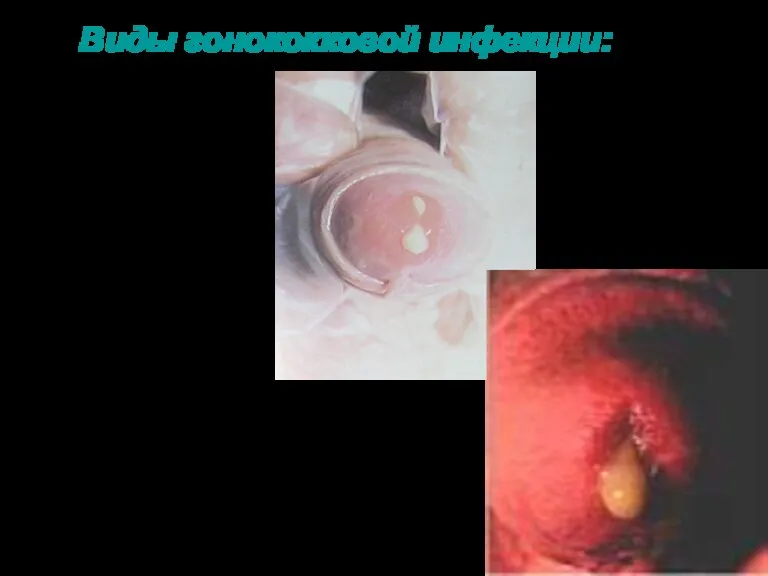 Виды гонококковой инфекции: Инфекция нижних отделов мочеполового тракта: - уретрит - цервицит