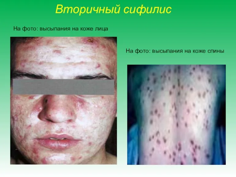 Вторичный сифилис На фото: высыпания на коже спины На фото: высыпания на коже лица