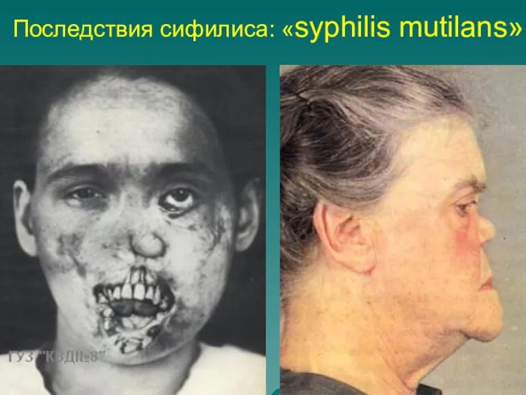 Последствия сифилиса: «syphilis mutilans»