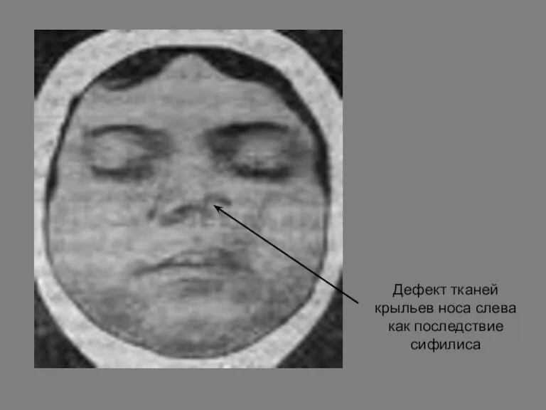 Дефект тканей крыльев носа слева как последствие сифилиса