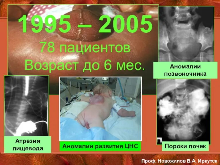 Атрезия пищевода Аномалии позвоночника Пороки почек 1995 – 2005 78
