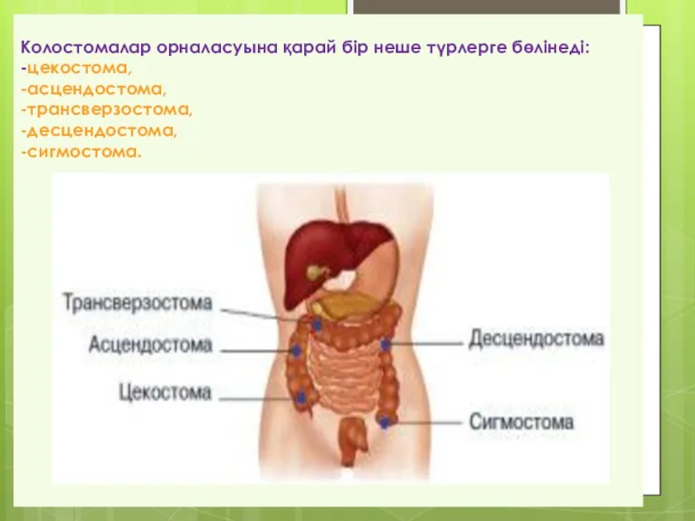 Колостомалар орналасуына қарай бір неше түрлерге бөлінеді: -цекостома, -асцендостома, -трансверзостома, -десцендостома, -сигмостома.