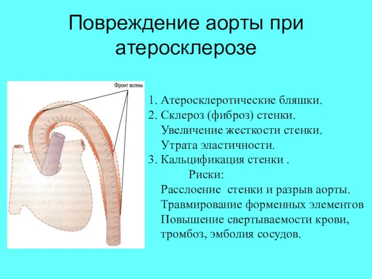 Повреждение аорты при атеросклерозе 1. Атеросклеротические бляшки. 2. Склероз (фиброз)