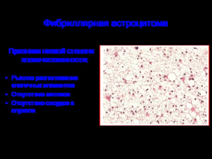 Фибриллярная астроцитома Признаки низкой степени злокачественности: Рыхлое расположение клеточных элементов Отсутствие митозов Отсутствие сосудов в опухоли
