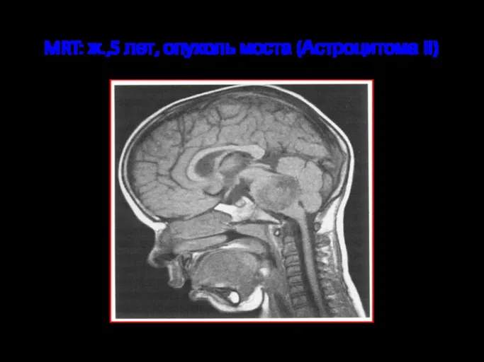 MRT: ж.,5 лет, опухоль моста (Астроцитома II)