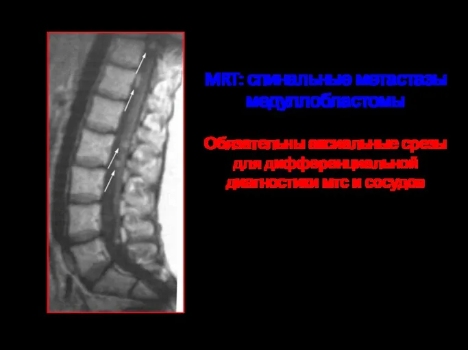 MRT: спинальные метастазы медуллобластомы Обязательны аксиальные срезы для дифференциальной диагностики мтс и сосудов
