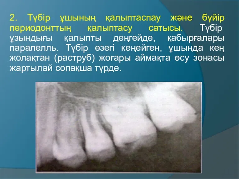 2. Түбір ұшының қалыптаспау және бүйір периодонттың қалыптасу сатысы. Түбір ұзындығы қалыпты деңгейде,