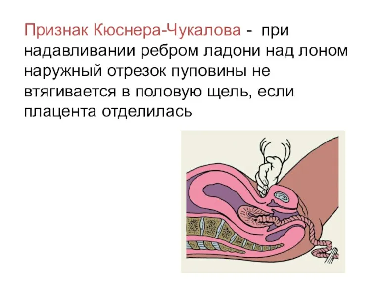 Признак Кюснера-Чукалова - при надавливании ребром ладони над лоном наружный отрезок пуповины не