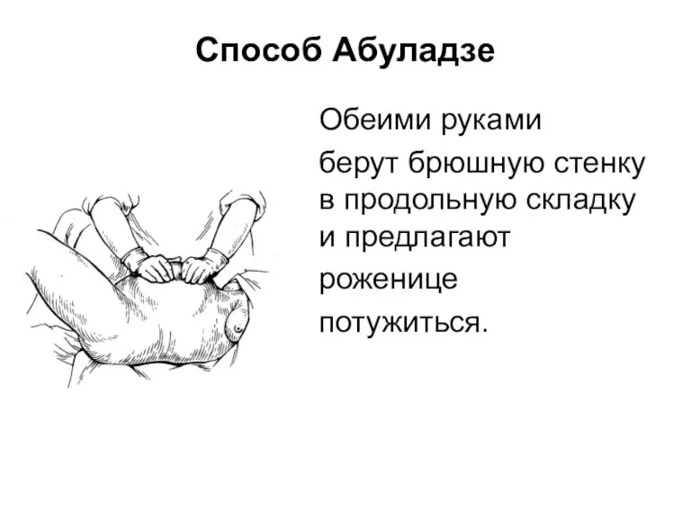 Способ Абуладзе Обеими руками берут брюшную стенку в продольную складку и предлагают роженице потужиться.