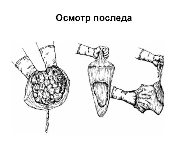 Осмотр последа