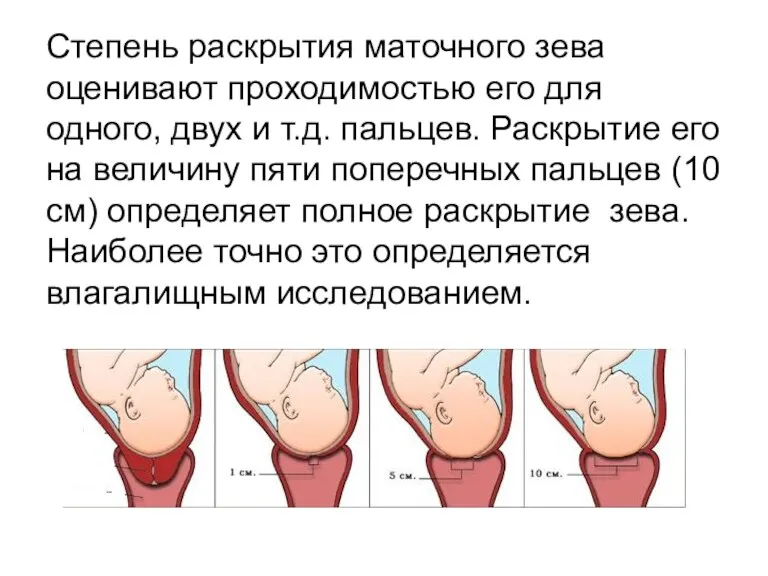 Степень раскрытия маточного зева оценивают проходимостью его для одного, двух и т.д. пальцев.