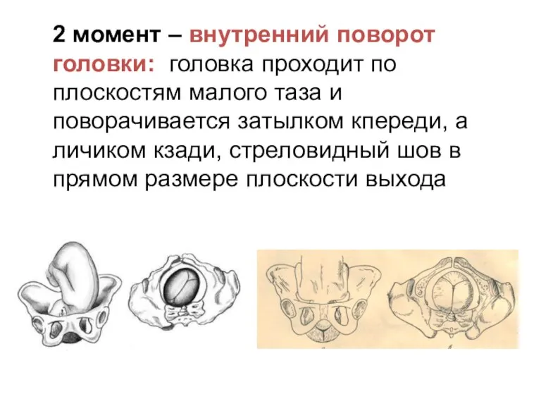 2 момент – внутренний поворот головки: головка проходит по плоскостям малого таза и