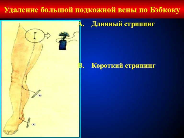 Удаление большой подкожной вены по Бэбкоку Длинный стрипинг Короткий стрипинг