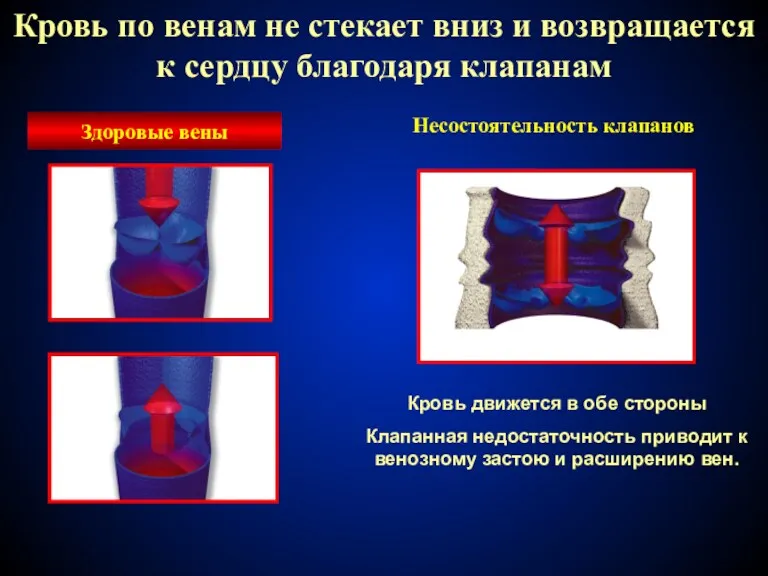 Здоровые вены Кровь движется в обе стороны Клапанная недостаточность приводит