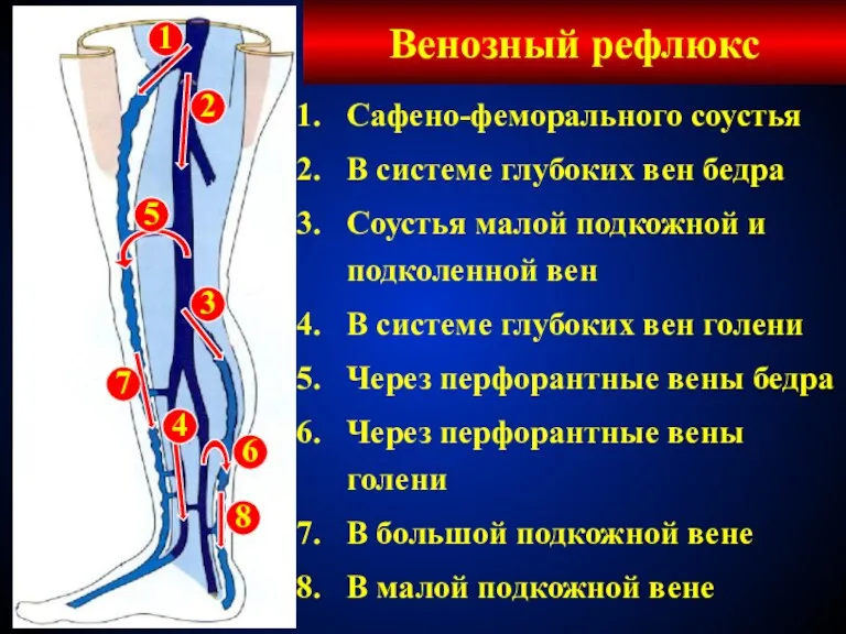 Венозный рефлюкс Сафено-феморального соустья В системе глубоких вен бедра Соустья малой подкожной и