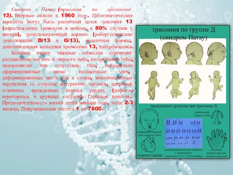 Синдром Патау (трисомия по хромосоме 13). Впервые описан в 1960