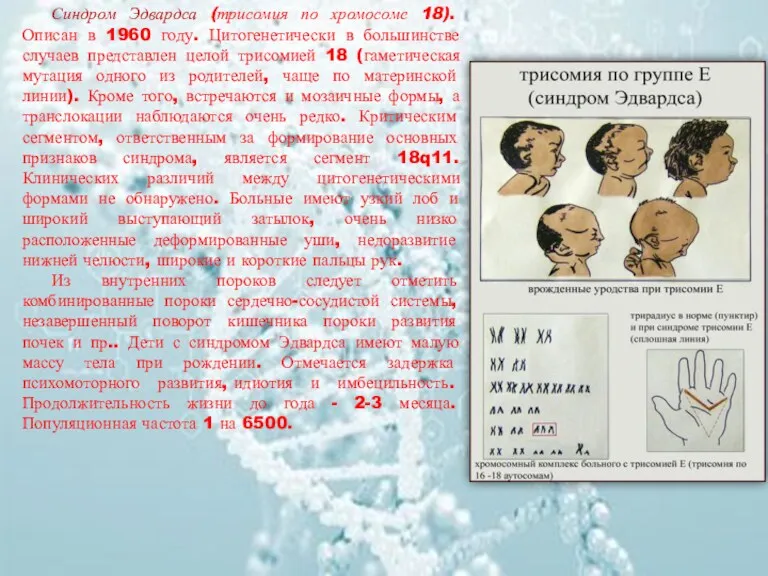 Синдром Эдвардса (трисомия по хромосоме 18). Описан в 1960 году.