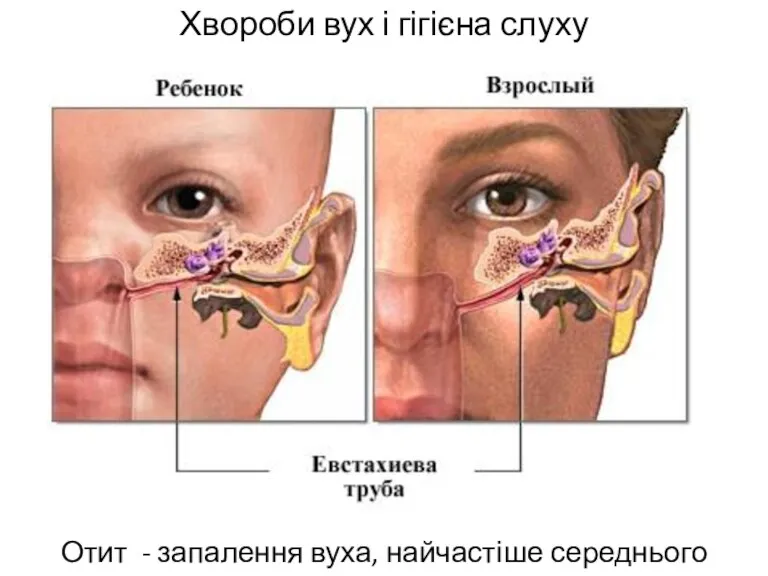 Хвороби вух і гігієна слуху Отит - запалення вуха, найчастіше середнього