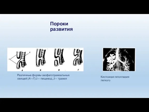Пороки развития Различные формы эзофаготрахеальных свищей (А—Г):1— пищевод, 2— трахея Кистозная гипоплазия легкого