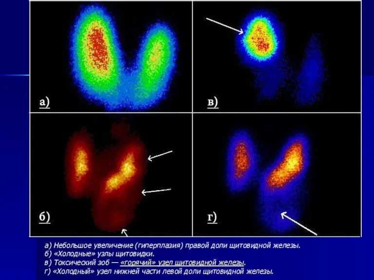 а) Небольшое увеличение (гиперплазия) правой доли щитовидной железы. б) «Холодные»