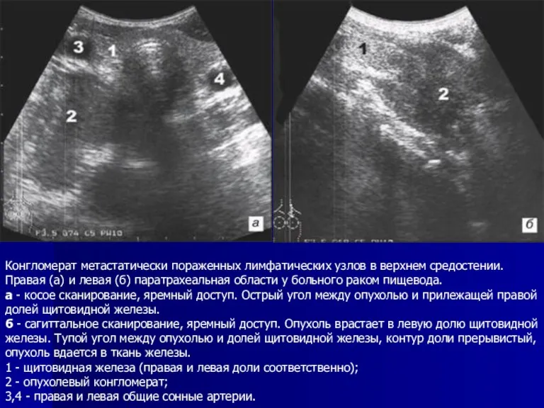 Конгломерат метастатически пораженных лимфатических узлов в верхнем средостении. Правая (а)