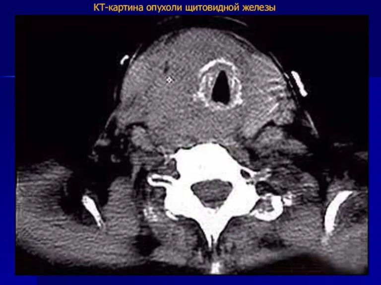 КТ-картина опухоли щитовидной железы