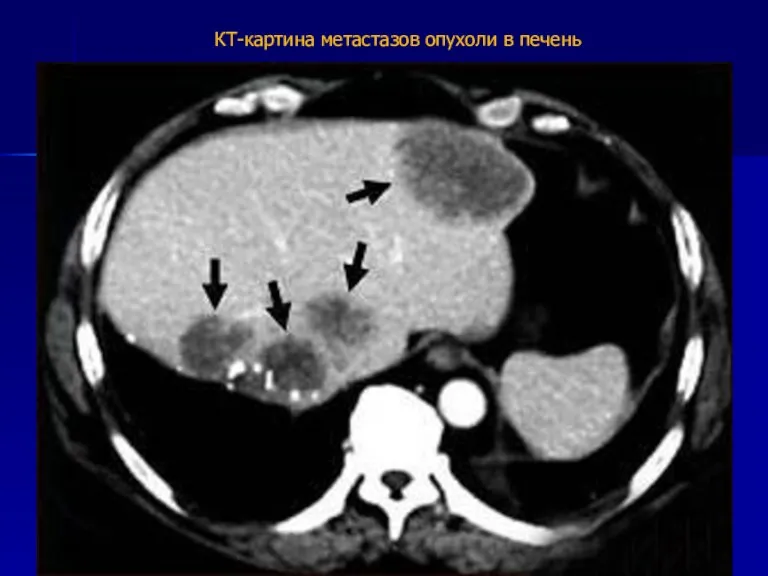 КТ-картина метастазов опухоли в печень