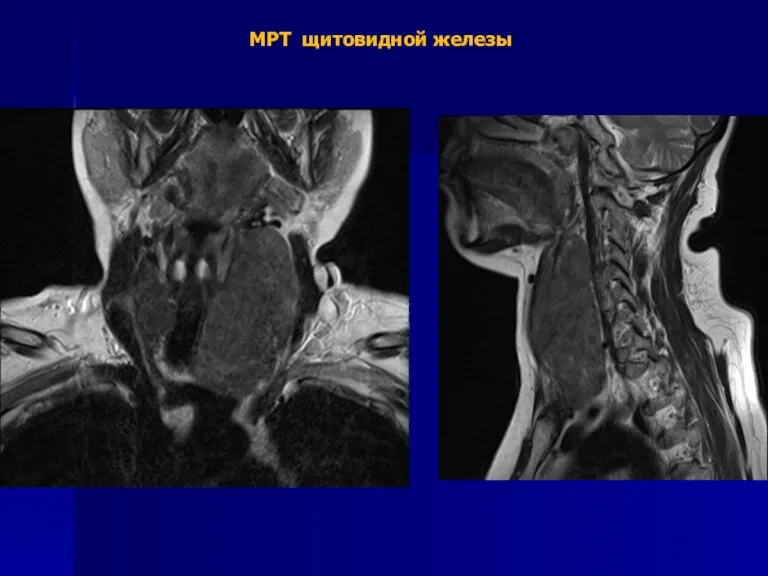 МРТ щитовидной железы