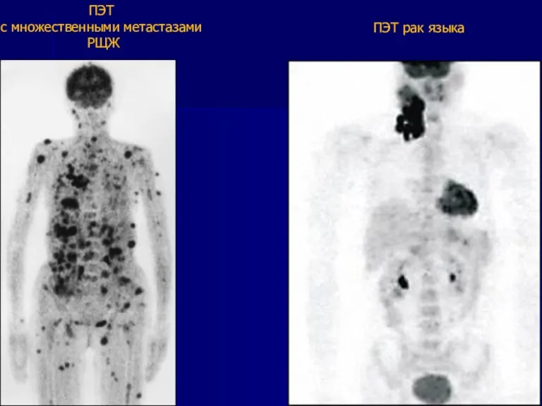 ПЭТ с множественными метастазами РЩЖ ПЭТ рак языка