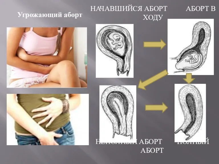 Угрожающий аборт НЕПОЛНЫЙ АБОРТ ПОЛНЫЙ АБОРТ НАЧАВШИЙСЯ АБОРТ АБОРТ В ХОДУ