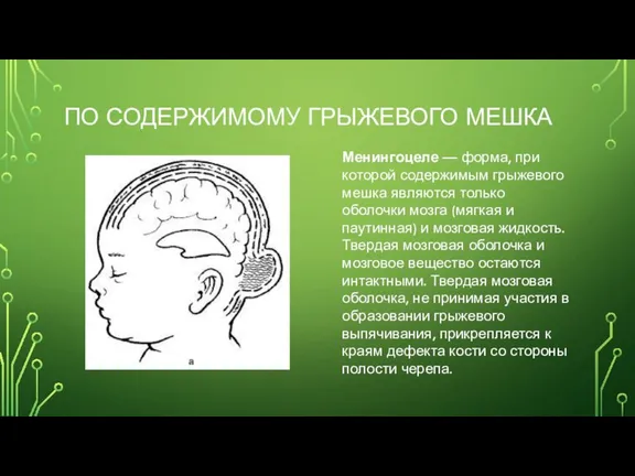 ПО СОДЕРЖИМОМУ ГРЫЖЕВОГО МЕШКА Менингоцеле — форма, при которой содержимым грыжевого мешка являются