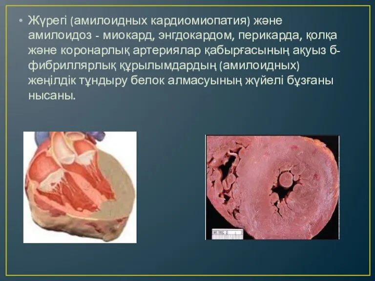 Жүрегі (амилоидных кардиомиопатия) және амилоидоз - миокард, энгдокардом, перикарда, қолқа