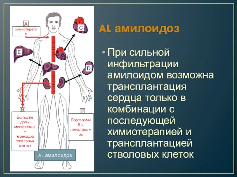 AL амилоидоз При сильной инфильтрации амилоидом возможна трансплантация сердца только