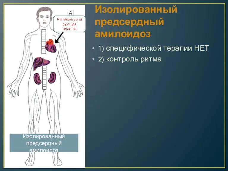 Изолированный предсердный амилоидоз 1) специфической терапии НЕТ 2) контроль ритма Изолированный предсердный амилоидоз Ритмконтролирующая терапия