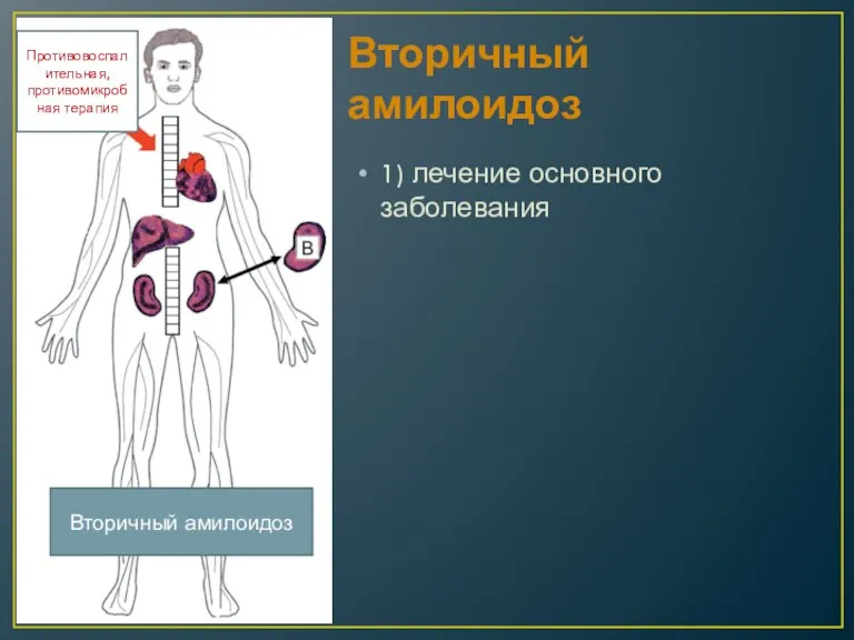 Вторичный амилоидоз 1) лечение основного заболевания Противовоспалительная, противомикробная терапия Вторичный амилоидоз