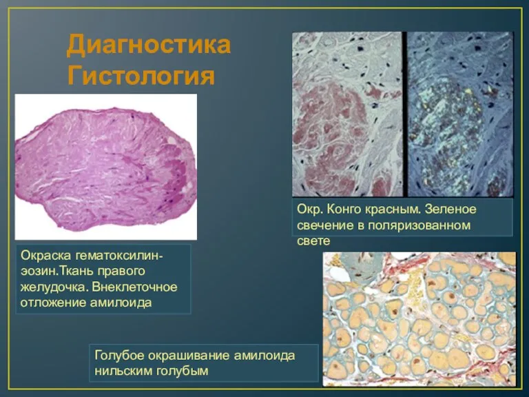 Диагностика Гистология Окраска гематоксилин-эозин.Ткань правого желудочка. Внеклеточное отложение амилоида Голубое